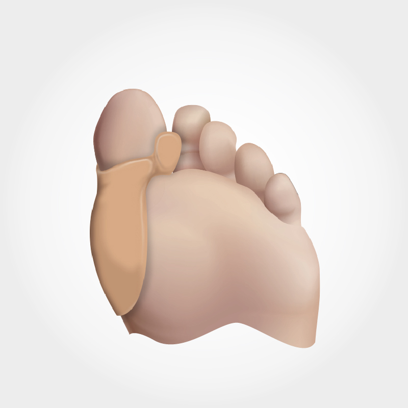 [831] Aurafix - Séparateur Orteil + Protege Hallux Valgus