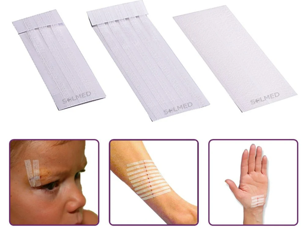 Skin closures - With adhesive wound closures 75mm